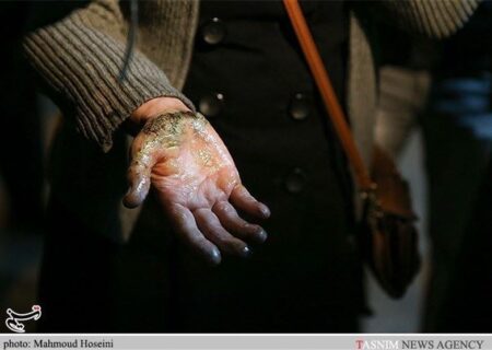 وقوع سالانه 300هزار مورد سوختگی/ تخت سوختگی استاندارد دولتی نداریم